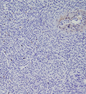 Microscopic image of a synovial sarcoma biopsy.